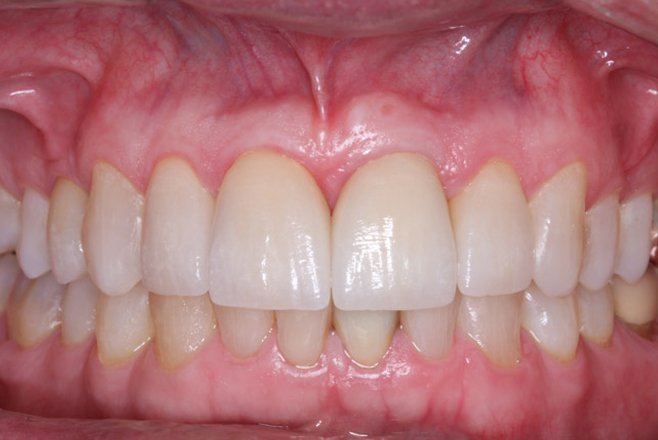 dental instruments for dealing with cavities