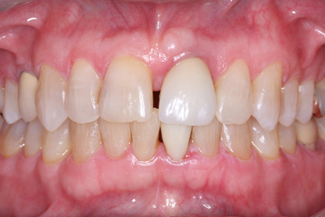 dental instruments for dealing with cavities