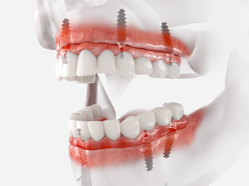 dental instruments for dealing with cavities
