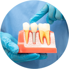 implants_image (1) (1)